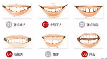 拿出镜子,教你轻松判断牙齿的整齐程度: 步:露齿笑,看中线